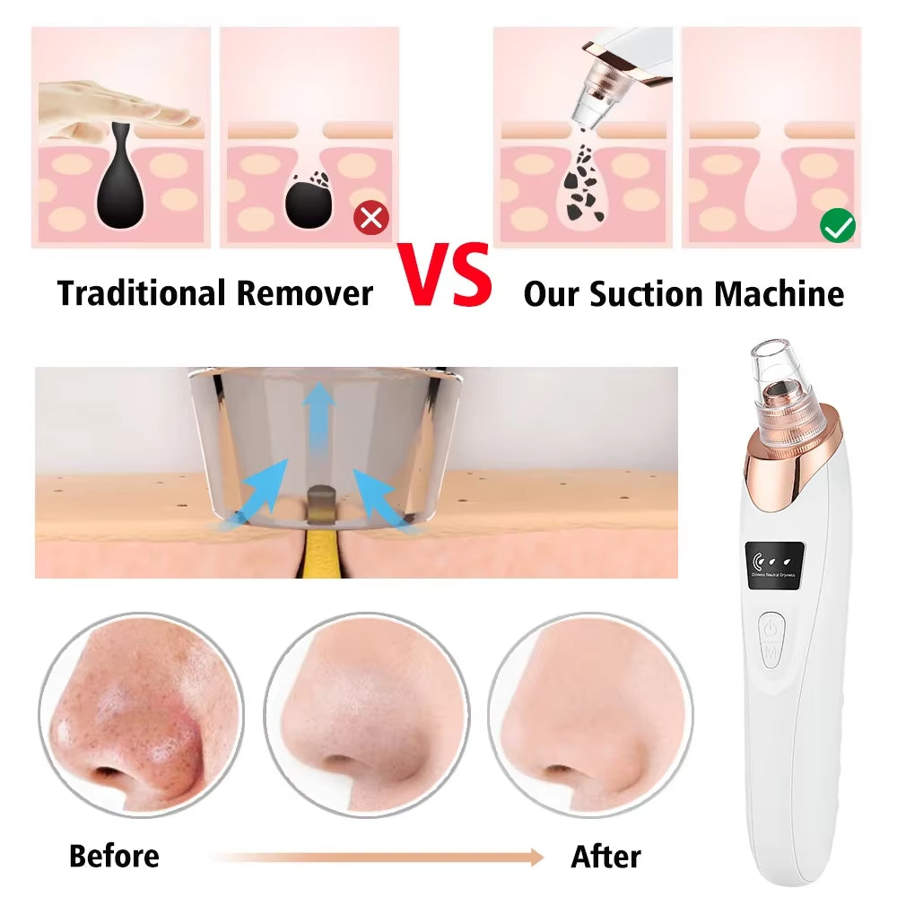 Vura Core: Advanced Pore Extraction System